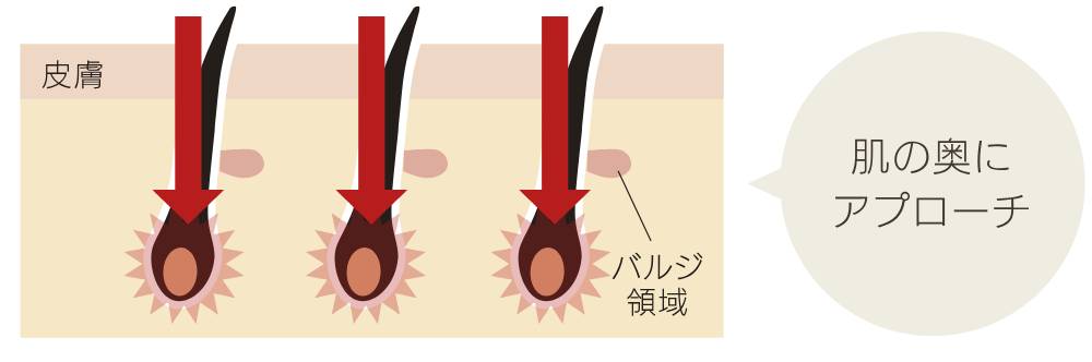 IPL（インテンス・パルス・ライト）方式